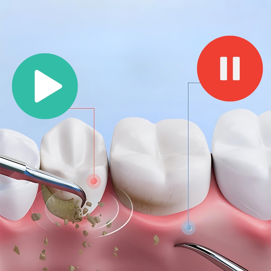 appareil détartrage KW gencives appareil détartrage KW gencives